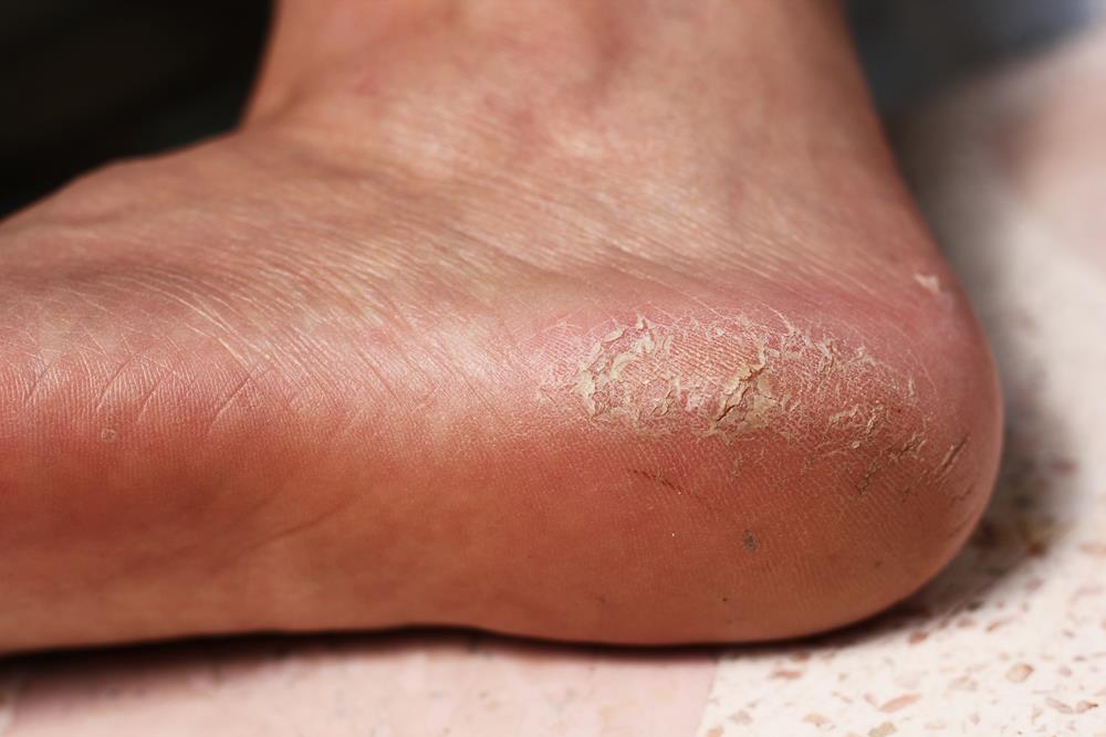 Calluses Weymouth, MA